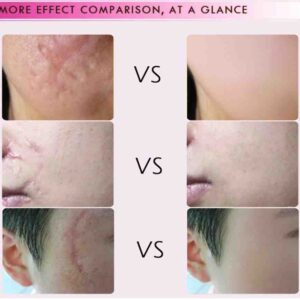 RtopR Acne Scar Remover Cream